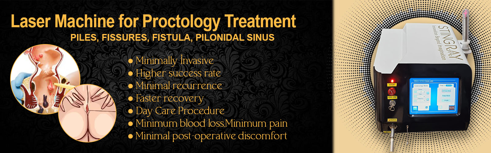 Laser Machine for Proctology Treatment in Delhi